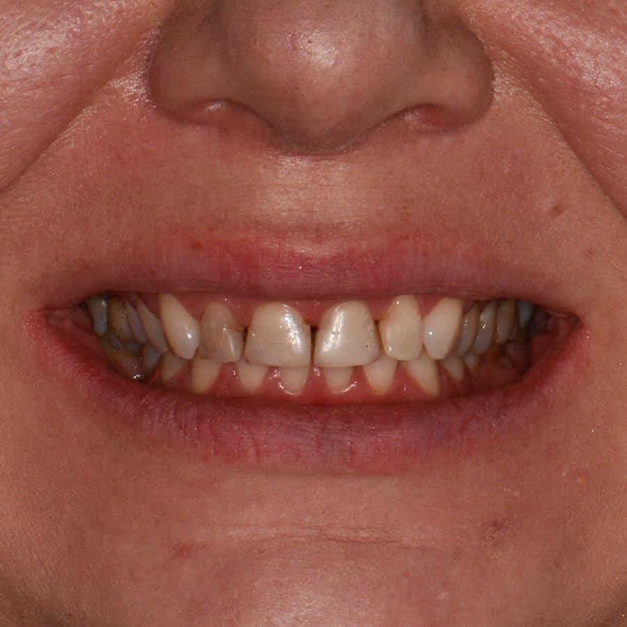 Metamorfoza z implantami — przed leczeniem