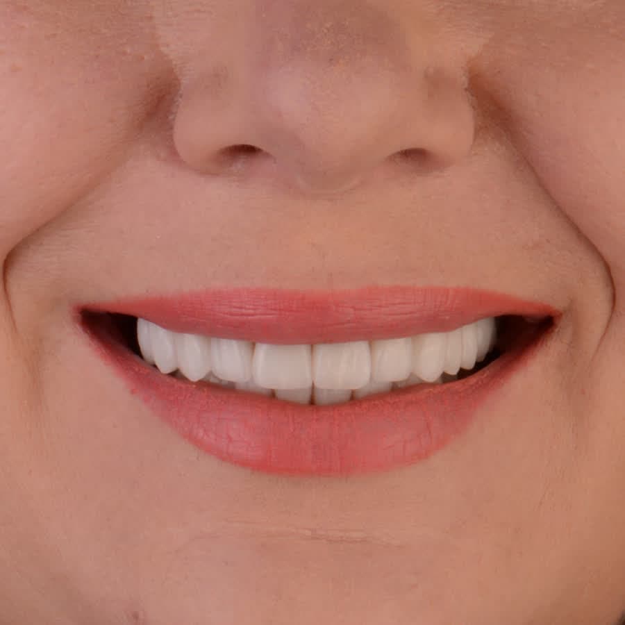 Metamorfoza z implantami — po leczeniu