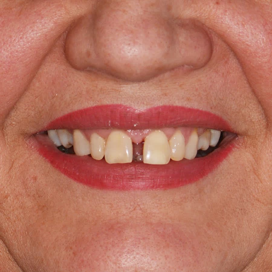 Kompletna rehabilitacja funkcjonalna — przed leczeniem