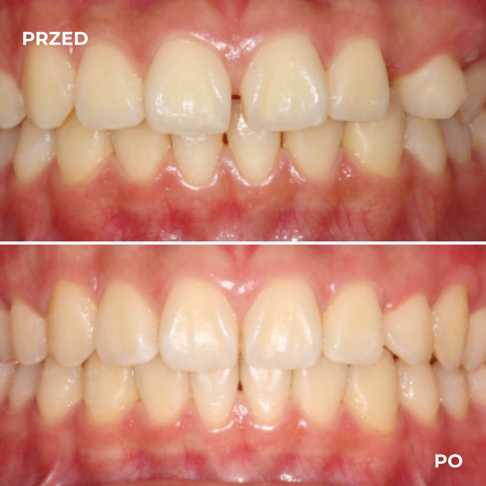 Pacjent — przypadek leczenia Invisalign (przed i po) — przykład 8